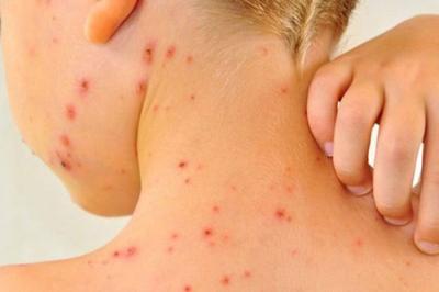 Kızamık yeniden ortaya çıkıyor Göz ardı edemeyeceğiniz sağlık uyarısı